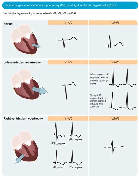 lv hl|electrocardiogram for lvh.